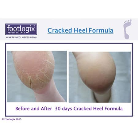 Footlogix Cracked Heel Formula - resultaat