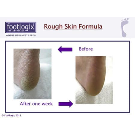 Footlogix Rough Skin Formula - resultaat