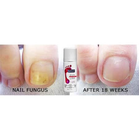 Footlogix kalknagel behandeling resultaat