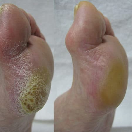 Resultaat Footlogix Professional Callus Softener
