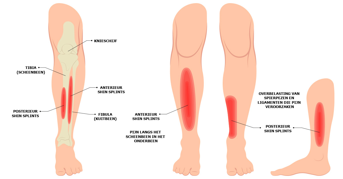 Shin Splints - uitleg - Skystep 01