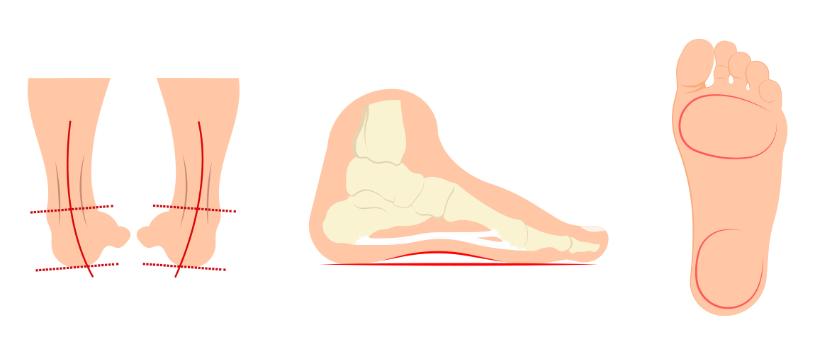 Hoe kun je een holvoet herkennen 01